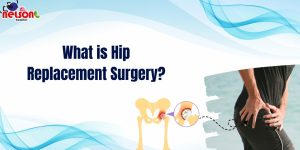 Hip Replacement Surgery
